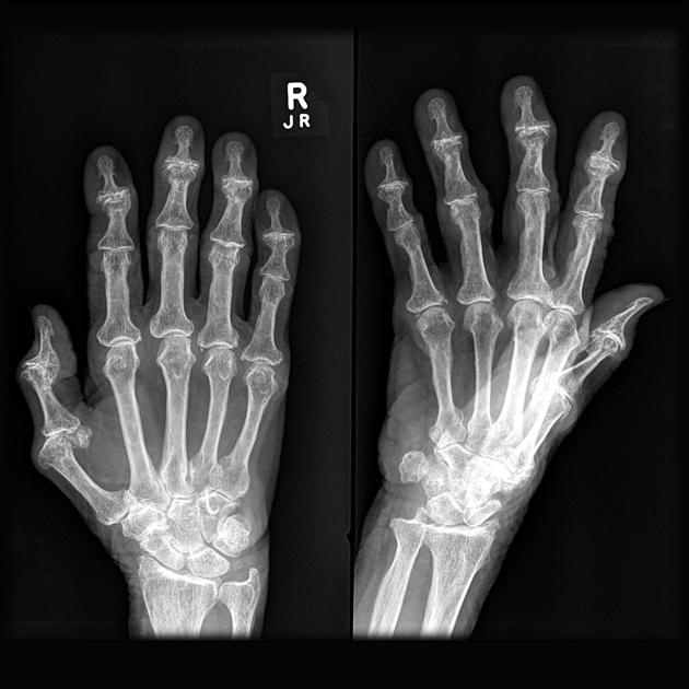 Osteoarthritis MSK Medbullets Step 1